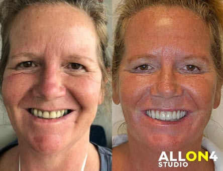 Before and after dental implants.