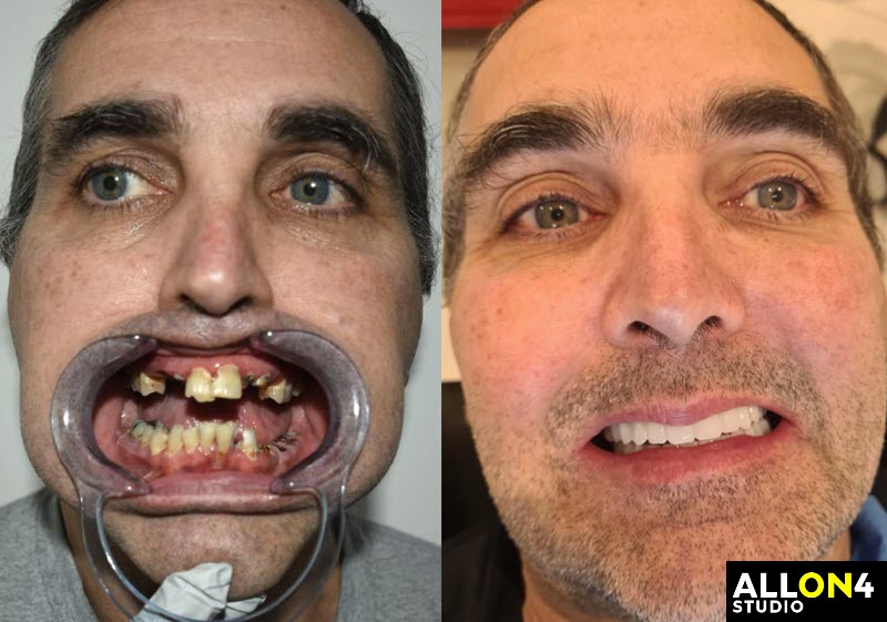 Before and after of All On 4 dental implants in Mexico