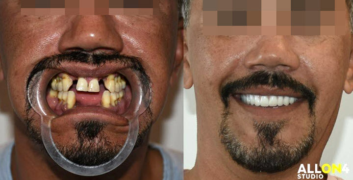 Mexican dental work in Cancun